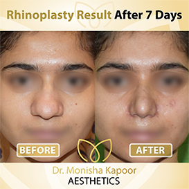 rhinoplasty-img16
